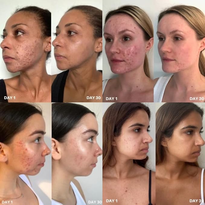 Clinisoothe+ Skin Purifier – Daily Cleanser and Acne Treatment for Face & Body, with Hypochlorous Technology to Prevent Breakouts & Promote Rapid Recovery, For All Skin Types (3.4oz Spray Bottle)