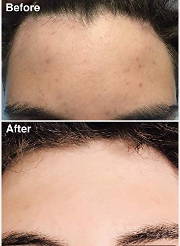 Teenology Conditioner for Teens - Avoid Forehead and Body Acne - Sulfate and Paraben Free, Noncomedogenic, Natural Botanical Extracts, Blueberry Pomegranate Cucumber - 16 oz.