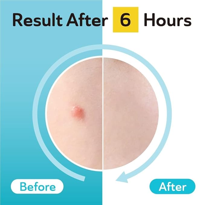 Dark Spot Patches Blemish Patches with Hydrocolloid, TXA & CICA for Active Acne & Post-Inflammatory Dark Spots - Day and Night Use - UPGRADED (Post Acne - 96 Count - 1 Size)