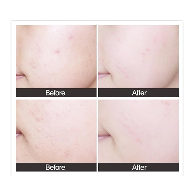 CRAZY SKIN Centella Tica Ampoule Serum 3.4 fl. oz. (100ml) - Natural Ingredients for Damaged, Troubled & Sensitive Skin, Redness Relief, Madecassic Acid Facial Serum Made in Korea