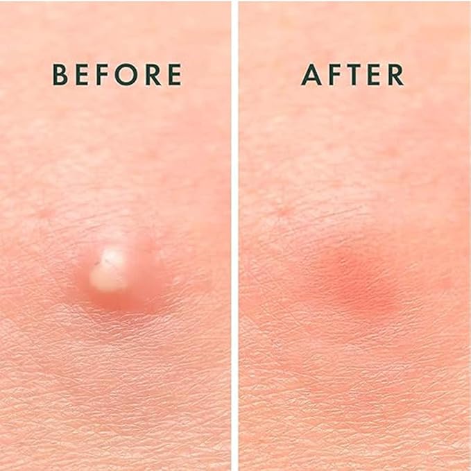 ABC Pimple Patches (36 Count)