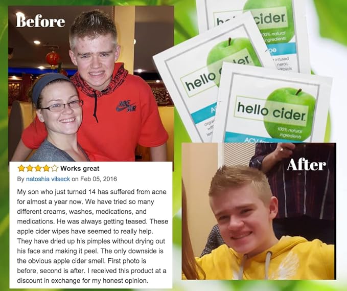 Apple Cider Vinegar Acne Face Wipes-Organic TeaTree, Rose, Chamomile, Witch Hazel.Oil free. Reduce Blemish & Acne. Tone,Restore, Sooth, Balance pH. Dry, Normal, Sensitive Skin. 25ct. USA Hello Cider