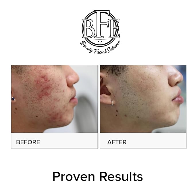 Acne Treatment Pads- Eliminates Cystic Breakouts, Oily Skin & Clogged Pores. Clear Pimple, Whitehead, Blackhead, Dark Spots & Improve Skin Texture.