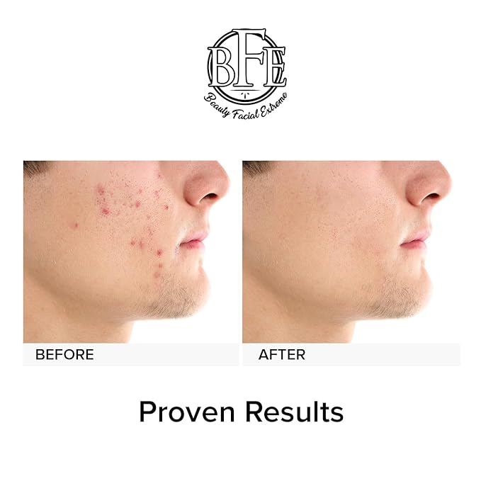 Acne Treatment Pads- Eliminates Cystic Breakouts, Oily Skin & Clogged Pores. Clear Pimple, Whitehead, Blackhead, Dark Spots & Improve Skin Texture.