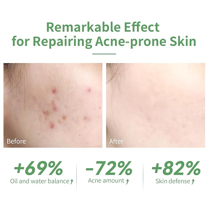 10% Salicylic Acid Serum, Acne Treatment for Face, 15ml/0.5oz, Minimize Pores, Active Skin Repair, Relieve Redness Blemish, Pimples Remover, Skin Barrier Repair for Acne Prone Sensitive Skin Care