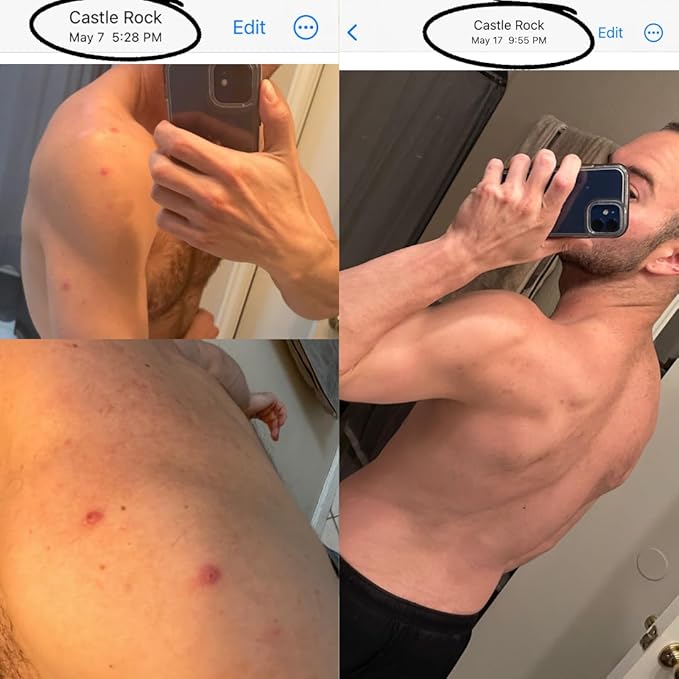 All Natural Body Acne Soap with Charcoal, Pumice, Tea Tree Oil & Vitamin E for a Deep Exfoliation Back Acne Treatment, Not for Sensitive Skin