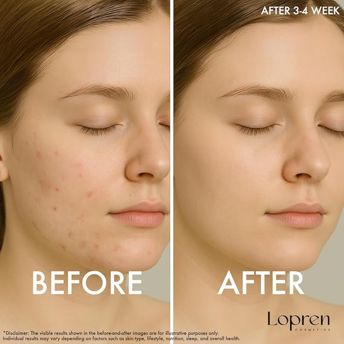 AHA 10% BHA 2% Exfoliating Serum, Skin Smoothing & Pore Refining Facial Serum, Supports a Clearer Complexion, 1 Fl Oz