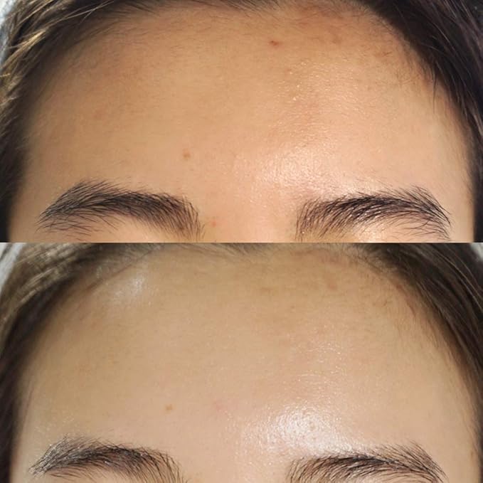 BONAJOUR] Extreme Acne Blemish repair&Soothing Cream - Intensive care for Acne and Skin Barrier Cream 1.75 fl.oz