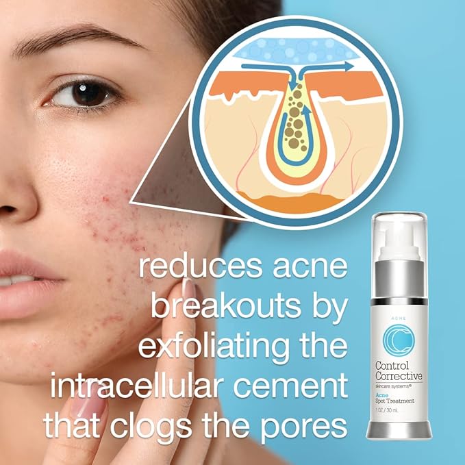 CONTROL CORRECTIVE Acne Spot Treatment, 1 Oz - Reduce & Treat Acne Breakouts, Potent Blend Of Lactic & Glycolic Acid, Exfoliating, Lightweight Gel, No Parabens Or Dyes, Calming Aloe Vera, Witch Hazel