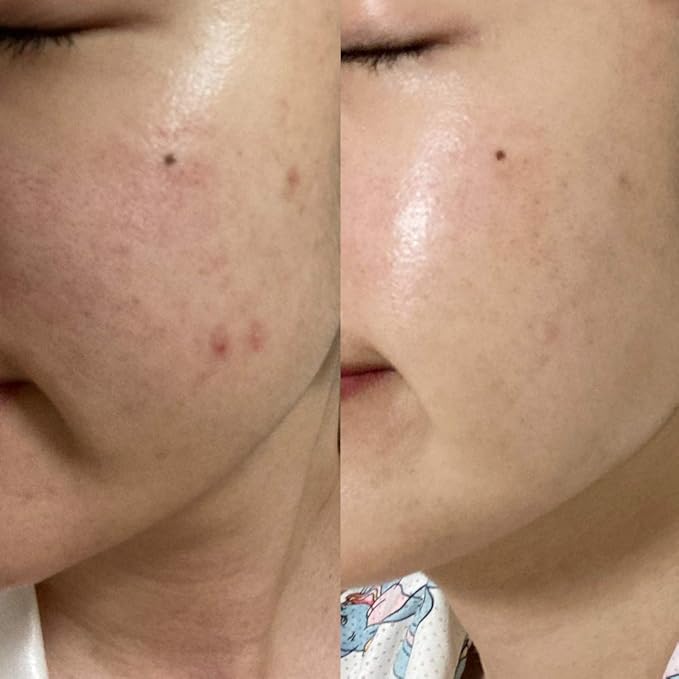 BONAJOUR] Extreme Acne Blemish repair&Soothing Cream - Intensive care for Acne and Skin Barrier Cream 1.75 fl.oz