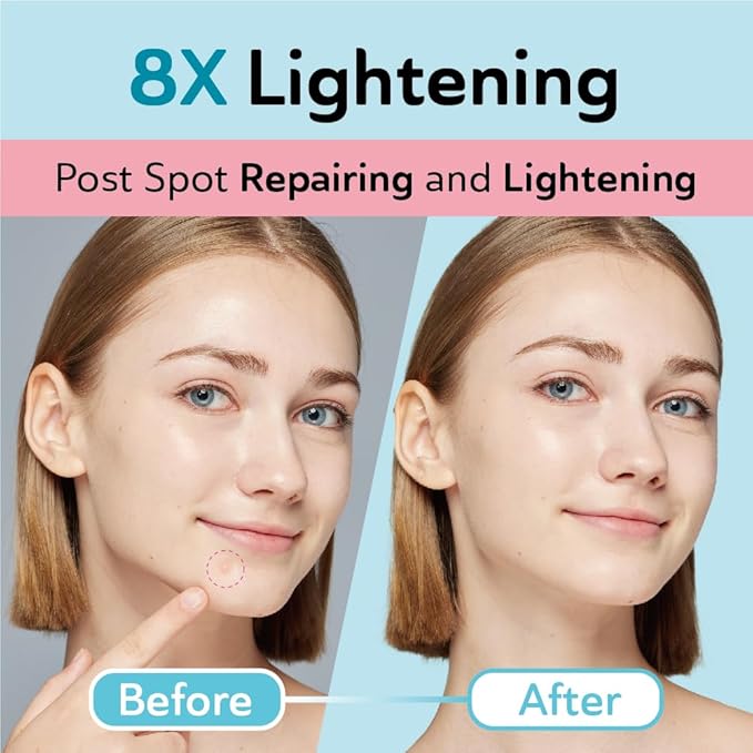 Dark Spot Patches Blemish Patches with Hydrocolloid, TXA & CICA for Active Acne & Post-Inflammatory Dark Spots - Day and Night Use - UPGRADED (Post Acne - 96 Count - 1 Size)