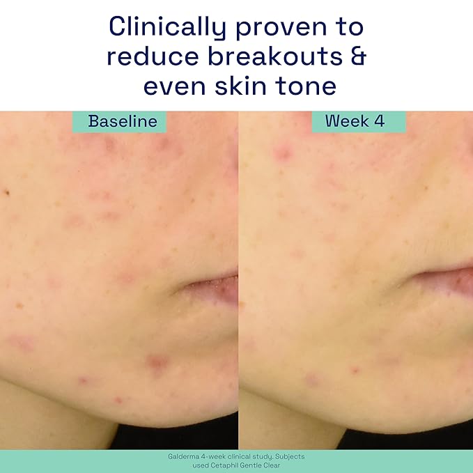 Cetaphil Gentle Clear Triple-Action Acne Treatment Serum with Salicylic Acid, Treats and Prevents Acne, Great for Post-Acne Marks, for All Skin Types, 1oz