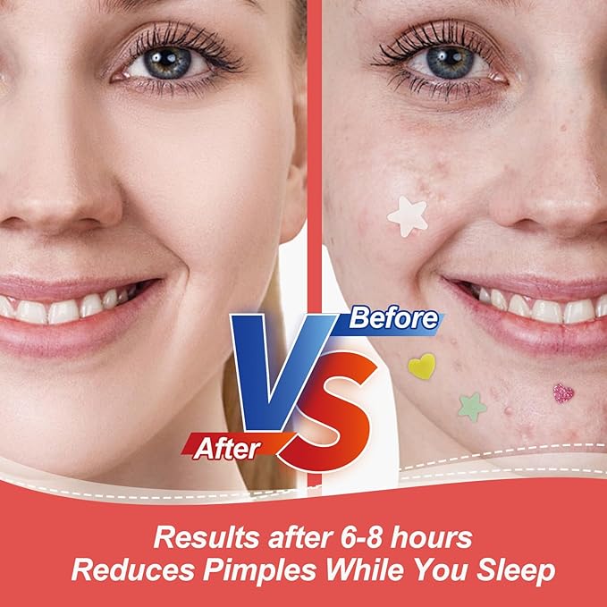 Clear Pimple Patches for Face 3 Size 400 Counts, Hydrocolloid Cute Star Acne Patches for Covering Zits and Blemishes, Zit Patches Spot Stickers Salicylic Acid,Tea Tree Oil, Pimple Popper Tool Kit
