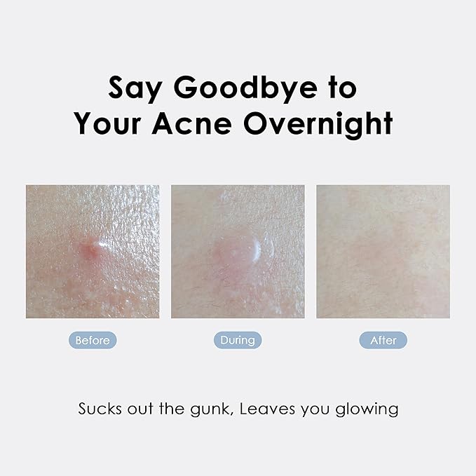 ASAP Active Spot Alleviating Patch [Bedtime] 52 Patches 8mm (16ea), 10mm (20ea) & 12mm (16ea) | Premium Hydrocolloid Dressing | Simple & Easy Active Treatment