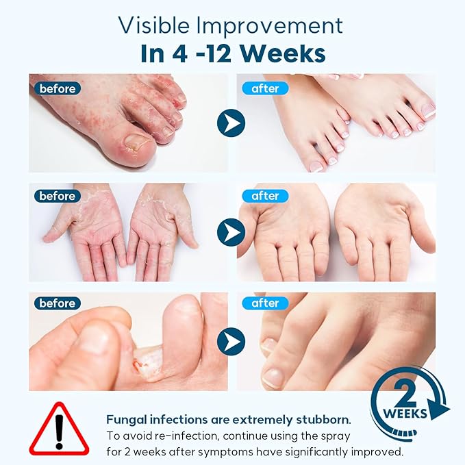 Athletes Foot Treatment, Natural Herbal Athletes Foot Spray for Most Athlete's Foot and Treat Symptoms of Molting, Blisters, Itching and Odor. (3Pcs, Fresh)