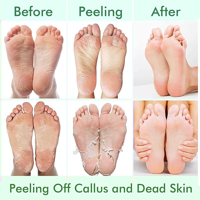 5 Pack Foot Peeling Mask,Exfoliator Peel Off Calluses Dead Skin Callus Remover,Foot Mask for Dry Cracked Feet,Foot Peel Mask for Men and Women Feet Peeling Mask for Mothers Day Gifts