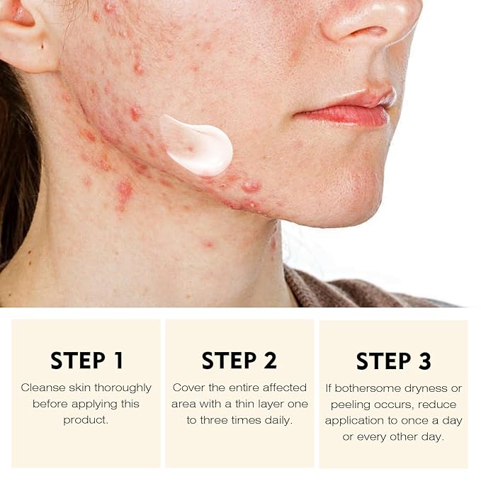 Acne Treatment for Face for Hormonal Cystic Stubborn Acne Cream for Sensitive Skin Teens Adults Women Men Spot Pimple Butt Control Rapid Clearing Breakout Overnight Face Blemish Treatment Moisturizer