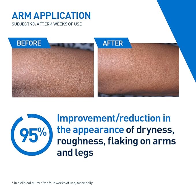 CeraVe Intensive Moisturizing Lotion, Hydro-Urea + Shea Butter, Body Lotion For Dry Skin, Relieves Signs Of Extra Dry Skin, Non Greasy Hydrating Cream For Rough, Tight, Red & Itchy Skin, 8oz