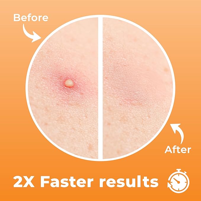 Chin Pimple Patches (12 Pack), Remove Chin Acne Overnight with Large Hydrocolloid Acne Patches For Blemishes on Chin, Cheek, Forehead