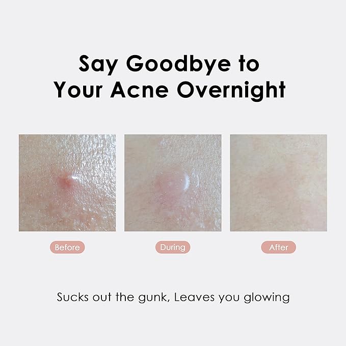 ASAP Active Spot Alleviating Patch 39 Patches [Daytime] 10mm (1 * 15ea) & 12mm (2 * 12ea) | Premium Hydrocolloid Dressing | Simple & Easy Active Treatment