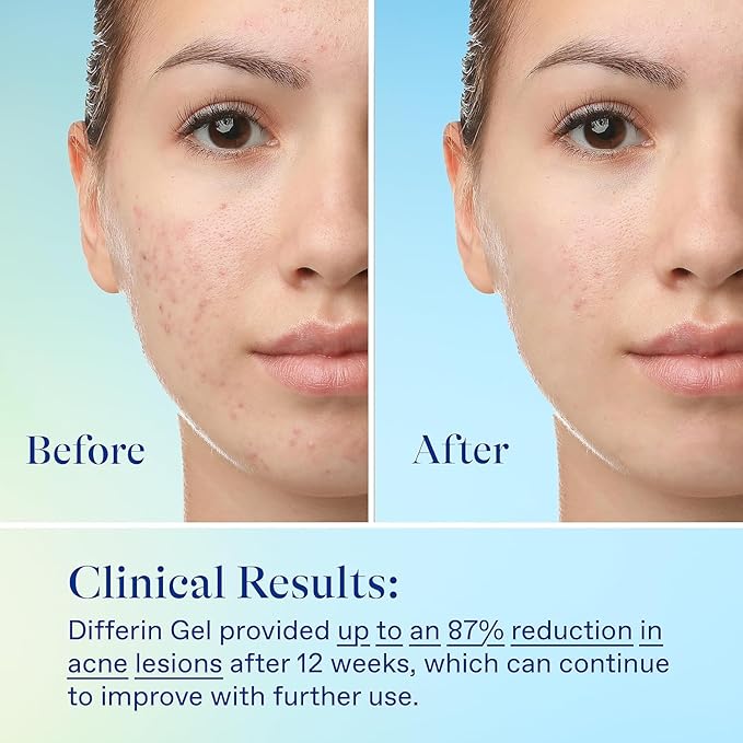 Differin Acne Skin Care Kit, Differin Gel Retinoid Acne Treatment for Face with 0.1% Adapalene & 5% Benzoyl Peroxide Face Wash & Body Wash, Designed for Pimple and Acne Prone Skin