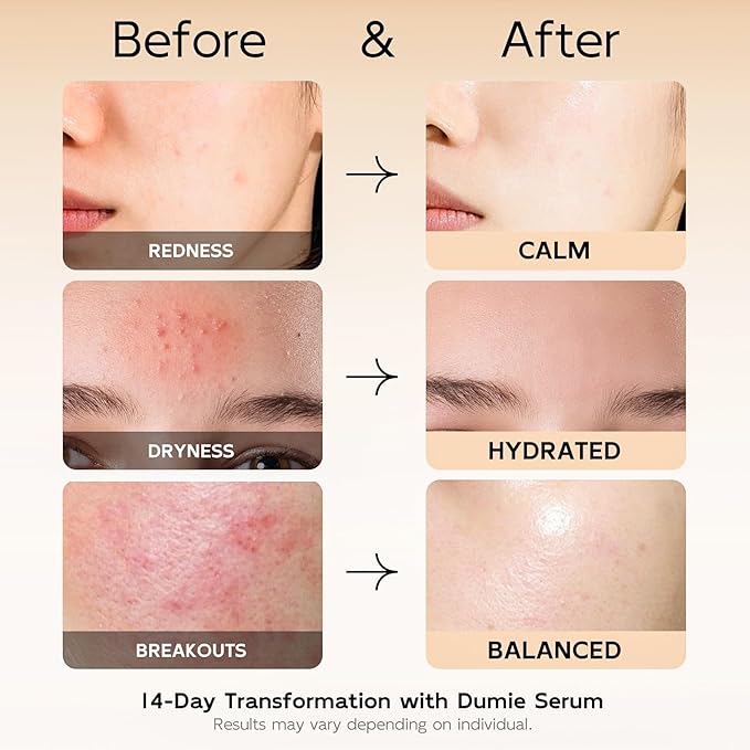 Azelaic Acid Serum 10%, Azelaic Acid For Face With Centella Asiatica Serum For Redness and Uneven Skin Tone, Hyaluronic Acid & Ceramide 3 – Soothes & Clears Pores For Sensitive Skin, 1.01 fl oz