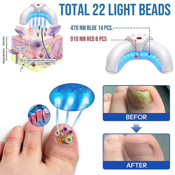 2025 New Nail-Fungus-Cleaning-Device for Multiple Toenails & Fingernails, Foldable Nail Fungus Light Device, Suitable for Discolored And Thickened Toenails, Easy to Use at Home
