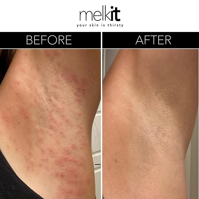 Body Melk Natural Body Cream - All Over Fast-Absorbing Hydration for Dry or Sensitive Skin - Soothe Sensitive Skin, Rash & Irritation - All Skin Types - 16 oz