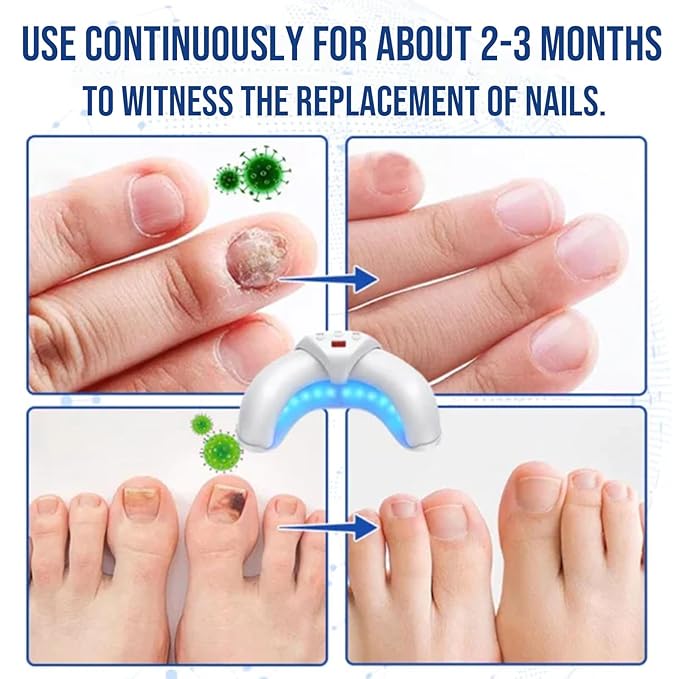 2025 New Nail-Fungus-Cleaning-Device for Multiple Toenails & Fingernails, Foldable Nail Fungus Light Device, Suitable for Discolored And Thickened Toenails, Easy to Use at Home