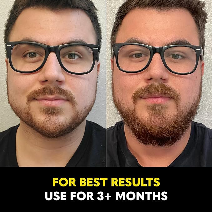 Beard Club - Beard Growth Serum with Natural Castor, Coconut and Avocado to Grow a Thicker, Fuller Beard, Fill in Patches and Stimulate Healthier Facial Hair Growth