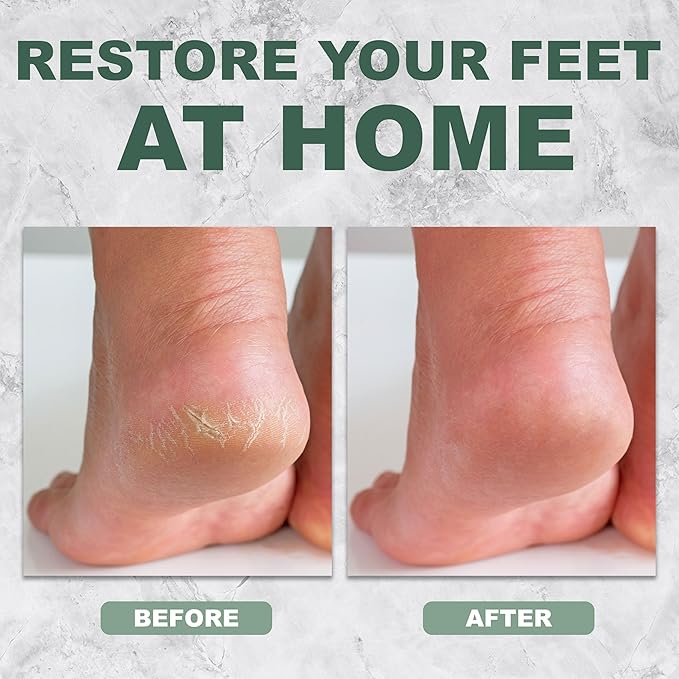 1pc Callus Remover Tool in Lilac - Professional Foot File Callus Remover for Feet, Premium Quality Foot Callus Shaver | Essential Calloused Feet Remover & Foot File for Dead Skin