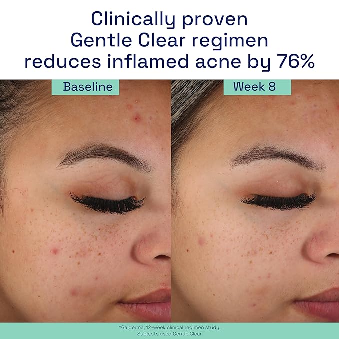 Cetaphil Acne Face Wash, Gentle Clear Clarifying Acne Cream Cleanser with 2% Salicylic Acid, Deep Cleans & Treats Acne Prone Skin, Skin Care for Sensitive Skin, 4.2oz