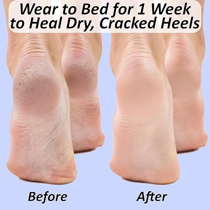 Cracked Heel Repair Kit: Moisturizing Socks, Foot Cream & Foot File, Cracked Heel Treatment, Heel Socks, Silicone Toeless Socks, Spa Gel Socks for Dry Cracked Feet Women, Pedicure Socks