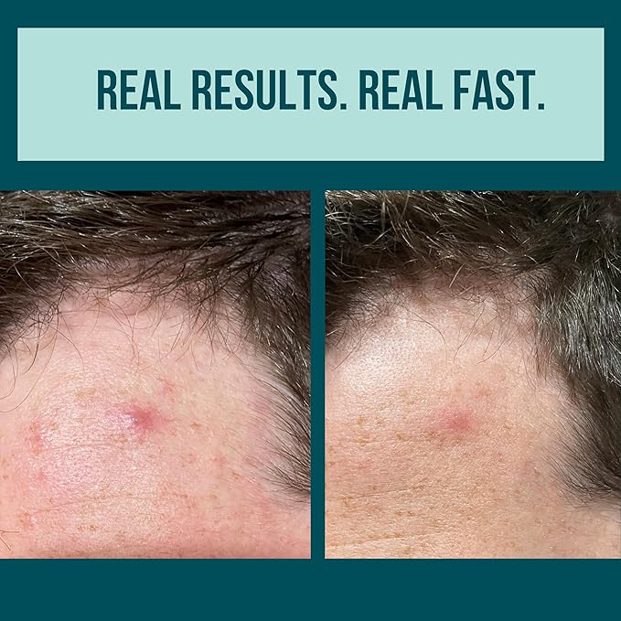 Cardon Microneedle Patches - Microdart Acne Patch with Salicylic Acid, Niacinamide & Hyaluronic Acid - Korean Pimple Patches to treat Zits, Blackheads, Blemishes, Razor Bumps, Ingrown Hair - (9 count)