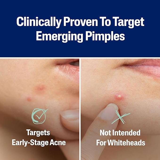 Cetaphil Acne Patches, Pimple Patches for Sensitive Skin, Formulated with Salicylic Acid, CICA, and Heartleaf Extract for Emerging Pimples, Visible Results in 6 Hours, 24 Count