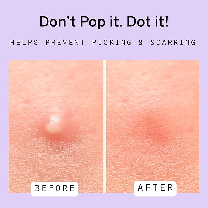 Dot Pimple Zit Patches for Face – Dermatologist Recommended & Ranked 1 for Most Effective Blemish Support – All Natural Hydrocolloid Acne Stickers with Vitamin C & Salicylic Acid (10 mm, 80 ct)