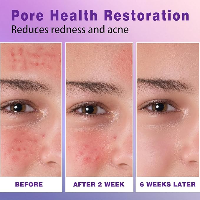 14% Azelaic Acid Acne Cream, Premium Azelaic Acid Facial Cream - Redness Relief For Face, Redness Reducing Skin Care, Prevents Acne Breakouts, Ease Pimple Clarify Skin Soothe Irritation,1 Oz