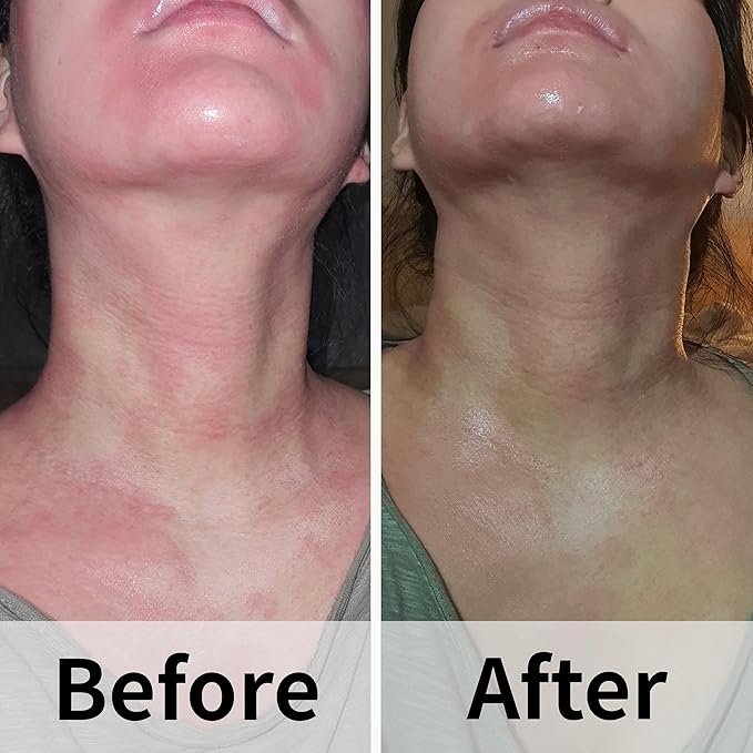 Ato Fast Calming Serum for Sensitive & Eczema-Prone Skin Instant Relief from Itch, Redness & Flare-Ups Powered by Cica & Panthenol 1.69 Fl Oz