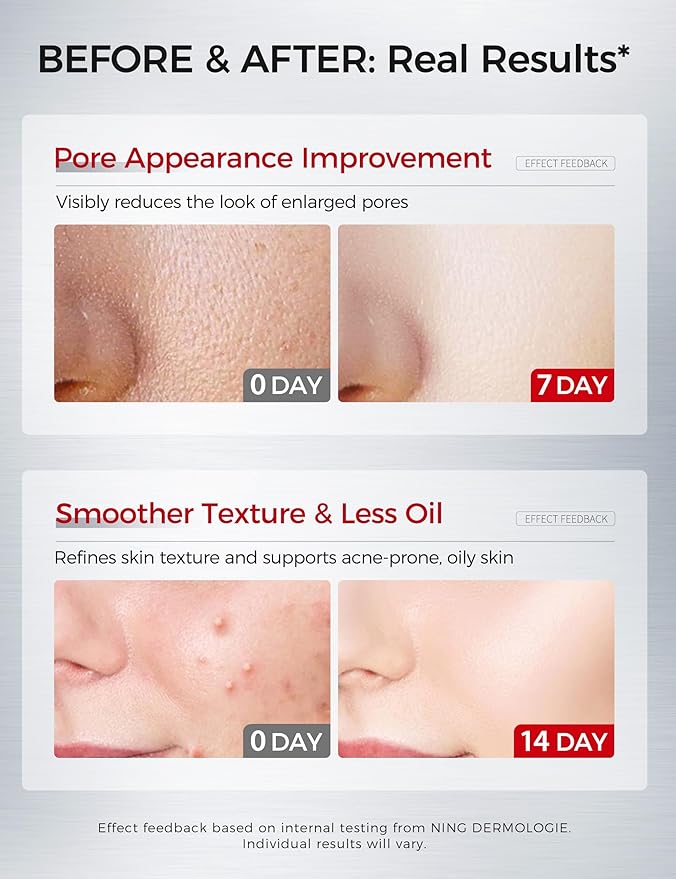 2% Salicylic Acid Serum for Acne Prone Skin | Pore Minimizer Exfoliant with AHA PHA Tranexamic Acid Niacinamide & Tembusu Extract | Oil Control & Blemish Treatment | 1 Fl Oz