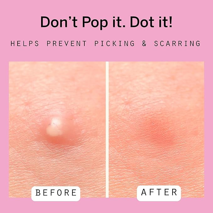 Dot Pimple Zit Patches for Face – Dermatologist Recommended & Ranked 1 for Most Effective Blemish Support – All Natural Hydrocolloid Acne Stickers with Vitamin C & Salicylic Acid (8, 10, 12 mm, 76 ct)