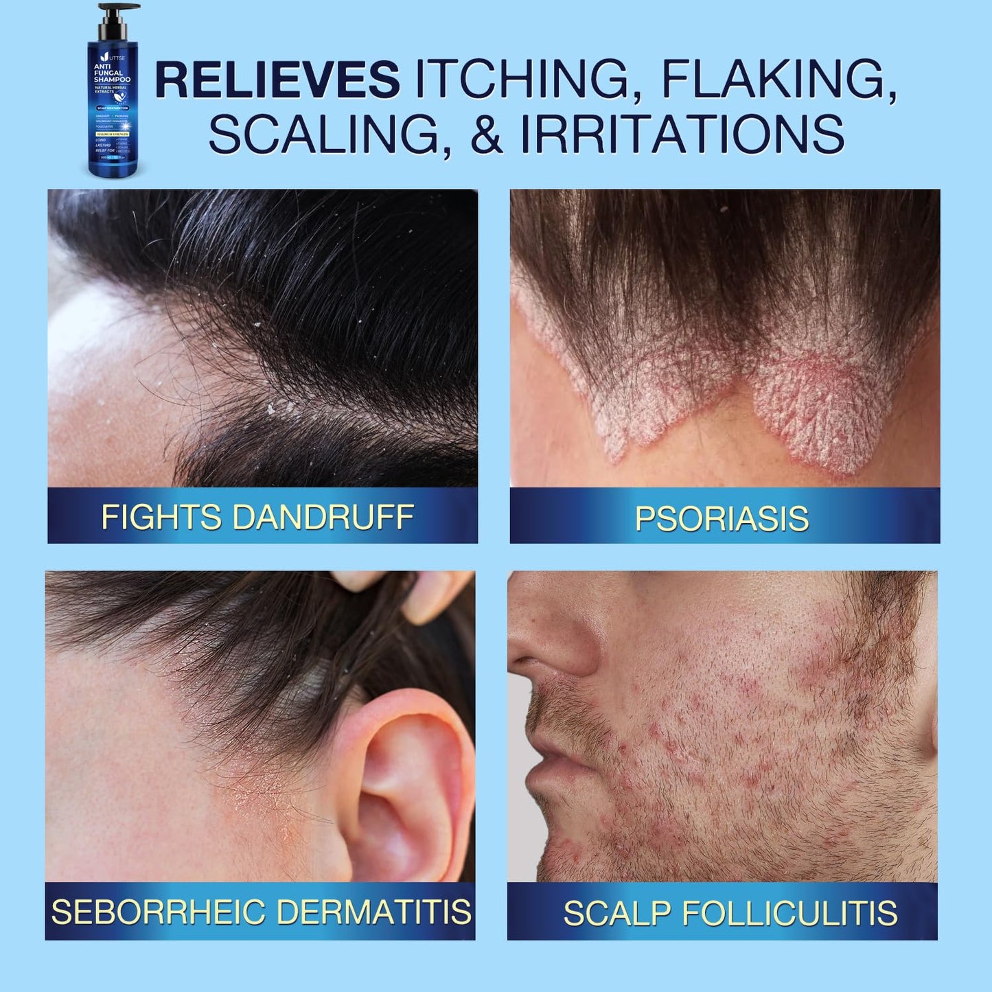 Anti-Fungal Shampoo for Scalp Psoriasis: Dandruff Shampoo for Folliculitis and Seborrheic Dermatitis - Relieves Itchy & Dry Scalp - 300 mL / 10.1 fl.oz