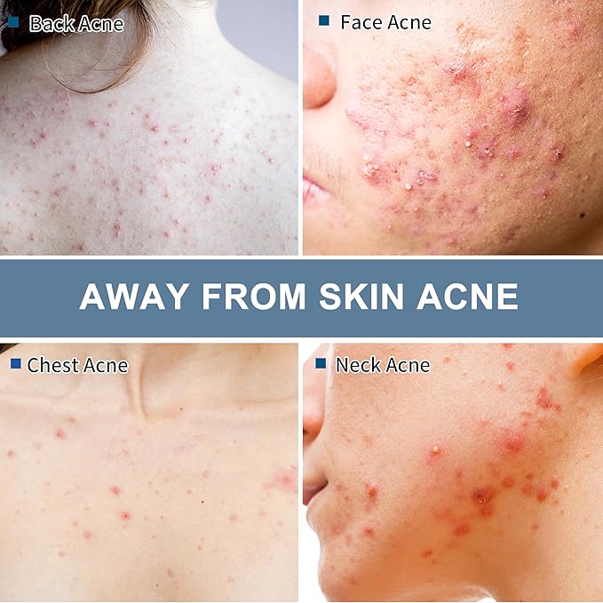 Acne Wipes for Face & Back, Acne Treatment Wipes with Salicylic Acid, Acne Scars and Dark Spot Remover with Natural Essential Oil for Face, Body, Back, and Butt